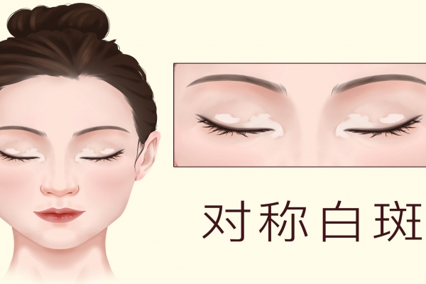 皮肤白斑