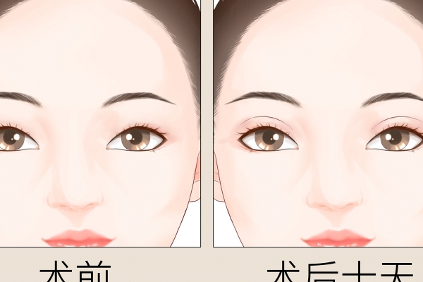 割双眼皮好不好