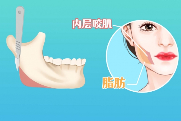 怎样消除咬肌